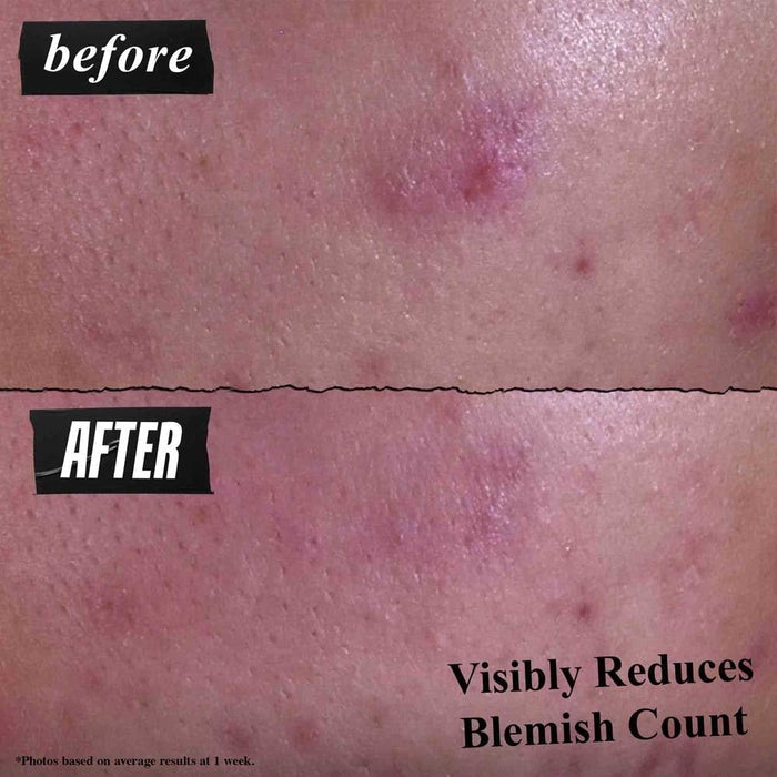 Kiehl's 2025 Acne Cleanser Row/ Gently Effective Blemish Targeting Cleansing Paste